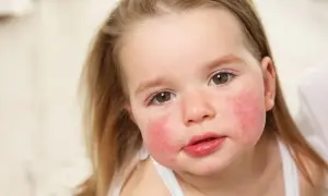 Czy olej z pestek malin uczula? Objawy i ryzyko reakcji alergicznych