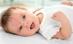 Czy witamina D może uczulać niemowlaka? Objawy i przyczyny alergii