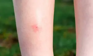 Czerwona, swędząca plamka na skórze nogi, będąca efektem ugryzienia meszki.