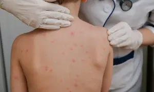 Dziecko z wysypką na plecach, badane przez lekarza w rękawiczkach.