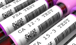 Rurki z próbkami krwi z etykietami: CEA TEST, PSA TEST, CA 12-5 TEST, CA 15-3 TEST.
