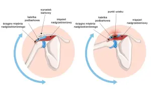 Ilustracja anatomiczna barku: prawidłowe położenie ścięgna i kaletki oraz ucisk na ścięgno.