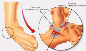 Ilustracja anatomiczna stawu skokowego z zaznaczonymi więzadłami i strzałką wskazującą skręt.