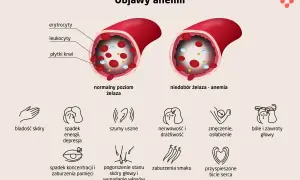 Objawy anemii: bladość skóry, spadek energii, szumy uszne, nerwowość, zmęczenie, bóle głowy, spadek koncentracji, pogorszenie stanu skóry i wypadanie włosów.