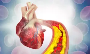 Serce z zatkanym naczyniem krwionośnym, gdzie gromadzi się żółty cholesterol, czyli wysoki poziom ldl.