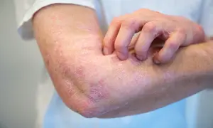 Łokieć z łuszczycą, osoba drapiąca swędzącą skórę.