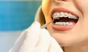 Uśmiech z aparatem ortodontycznym. Zastanawiasz się, ile kosztuje aparat na zęby? Dentysta sprawdza stan uzębienia.