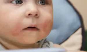 Twarz niemowlęcia z zaczerwienionymi policzkami i suchą skórą.