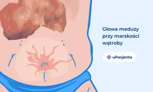 Ilustracja przedstawia brzuch z widocznymi żylakami i powiększoną wątrobą, symbolizującymi stan, gdy wyleczyłem marskość wątroby.