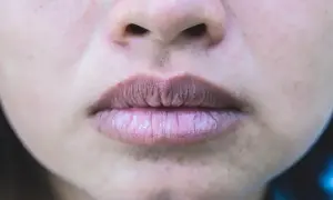 Usta z suchą, spierzchniętą skórą, która może być objawem **sinicy** lub odwodnienia.