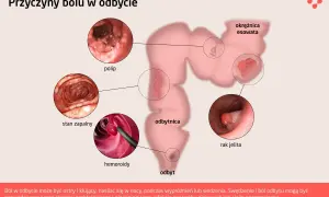 Ilustracja przedstawia przyczyny bólu w odbycie: polipy, stan zapalny, hemoroidy, raka jelita. Ból odbytu może być objawem wielu schorzeń.