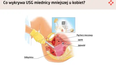 Ilustracja przedstawia badanie usg transwaginalne, pokazując narządy miednicy mniejszej: pęcherz moczowy, jajnik, jajowód i odbytnicę.