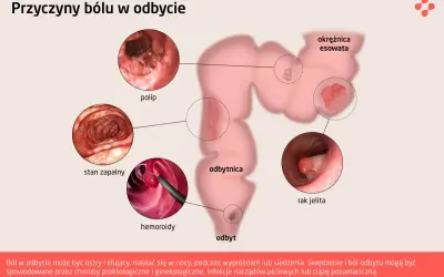 Ilustracja przedstawia przyczyny bólu w odbycie: polipy, stan zapalny, hemoroidy, raka jelita. Ból odbytu może być objawem wielu schorzeń.