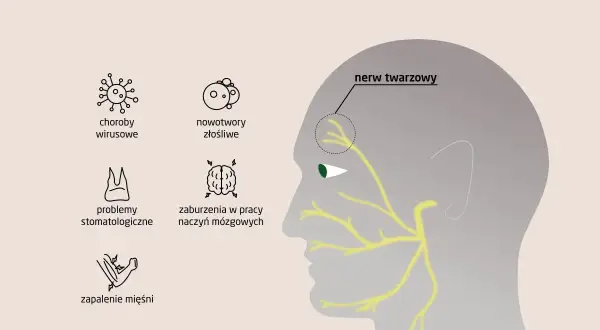 Ilustracja przedstawia przyczyny zapalenia nerwu twarzowego: wirusy, nowotwory, problemy stomatologiczne, zaburzenia naczyń mózgowych i zapalenie mięśni.