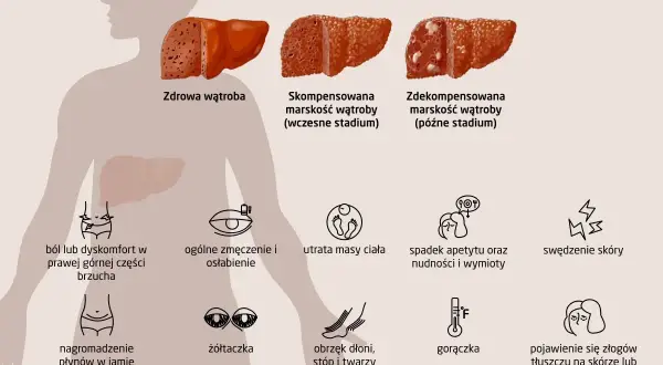Objawy marskości wątroby: ból brzucha, zmęczenie, utrata masy ciała, żółtaczka, obrzęki, gorączka, swędzenie skóry, złogi tłuszczu. Wzw b może prowadzić do marskości.
