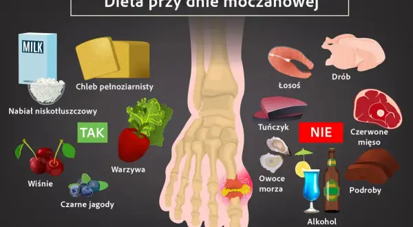 Dieta przy dnie moczanowej: zalecane nabiał, chleb pełnoziarnisty, warzywa, wiśnie, jagody. Unikaj czerwonego mięsa, podrobów, owoców morza, alkoholu. Leczenie wymaga zmian.