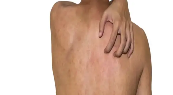 Czy kurkuma uczula? Objawy alergii i ryzyko reakcji alergicznych
