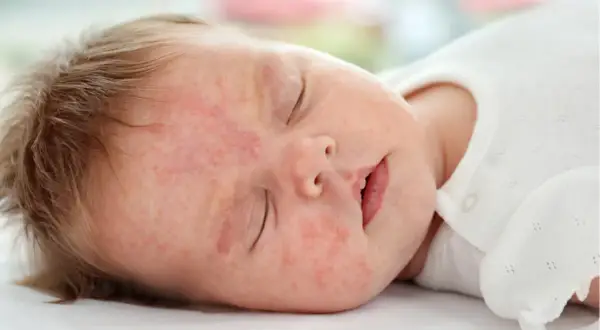 Alergia na mleko modyfikowane objawy – jak je rozpoznać i unikać?