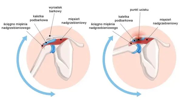Ilustracja anatomiczna barku: prawidłowe położenie ścięgna i kaletki oraz ucisk na ścięgno.