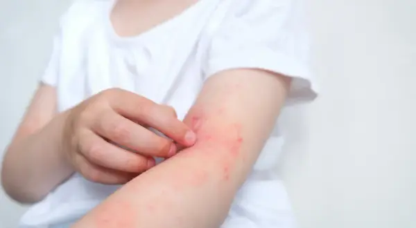 Alergia na nabiał objawy: jak je rozpoznać i uniknąć problemów