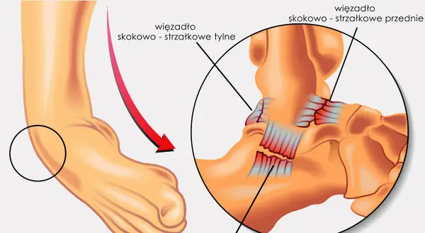 Ilustracja anatomiczna stawu skokowego z zaznaczonymi więzadłami i strzałką wskazującą skręt.