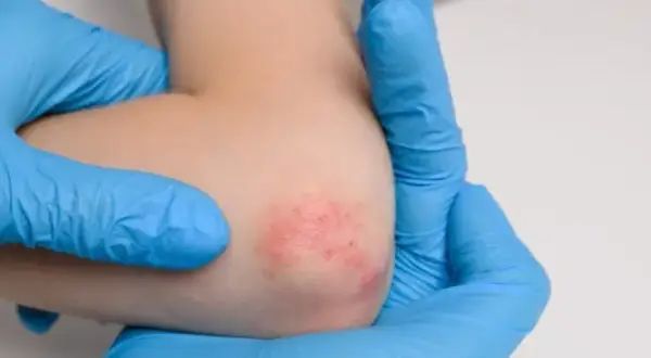 Alergia na konserwanty objawy: Jak rozpoznać niebezpieczne reakcje