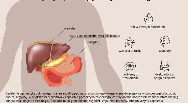 Ilustracja anatomiczna przedstawiająca wątrobę, pęcherzyk żółciowy i żołądek z objawami zapalenia.