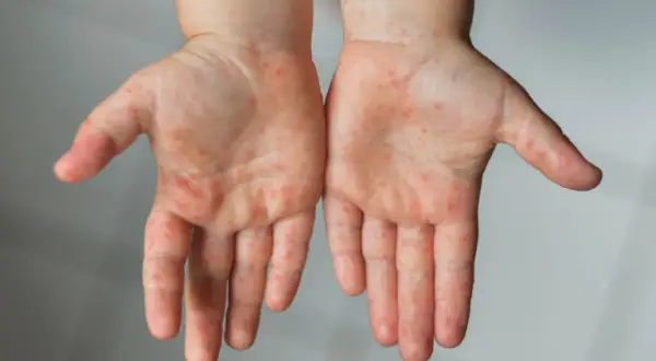 Alergia na lateks objawy - jak rozpoznać niebezpieczne reakcje?