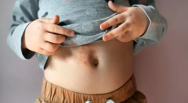 Czy alergia może pojawić się później? Zaskakujące fakty o alergiach