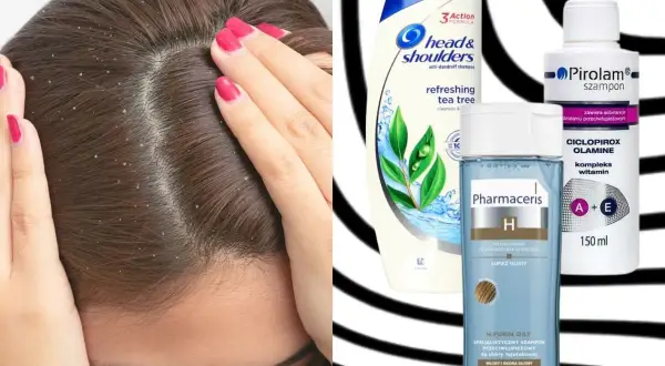 Jak pozbyć się łupieżu? Na zdjęciu widać skórę głowy z łupieżem i szampony przeciwłupieżowe: Head & Shoulders, Pirolam, Pharmaceris.