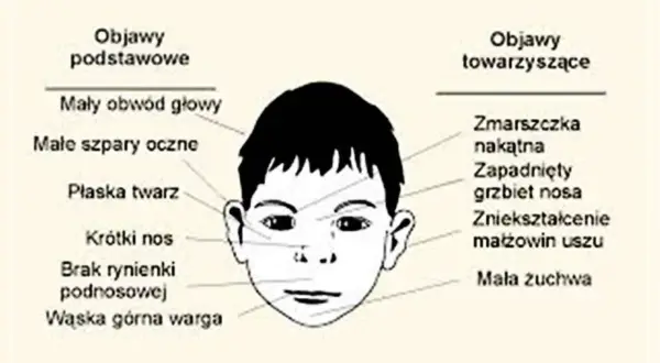 Ilustracja przedstawia twarz dziecka z zaznaczonymi objawami: mały obwód głowy, płaska twarz, krótki nos, wąska górna warga, zmarszczka nakątna, zapadnięty grzbiet nosa, zniekształcenie małżowin uszu.