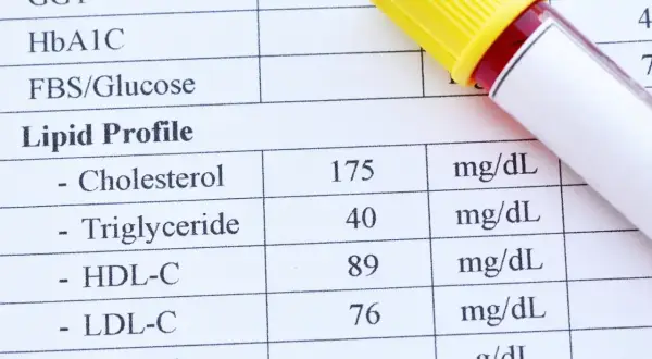 Wynik lipidogramu z próbką krwi. Wyniki wskazują na dyslipidemię, wymagającą dalszej diagnostyki.
