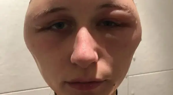 Alergia na farby do włosów objawy - jak uniknąć niebezpiecznych reakcji