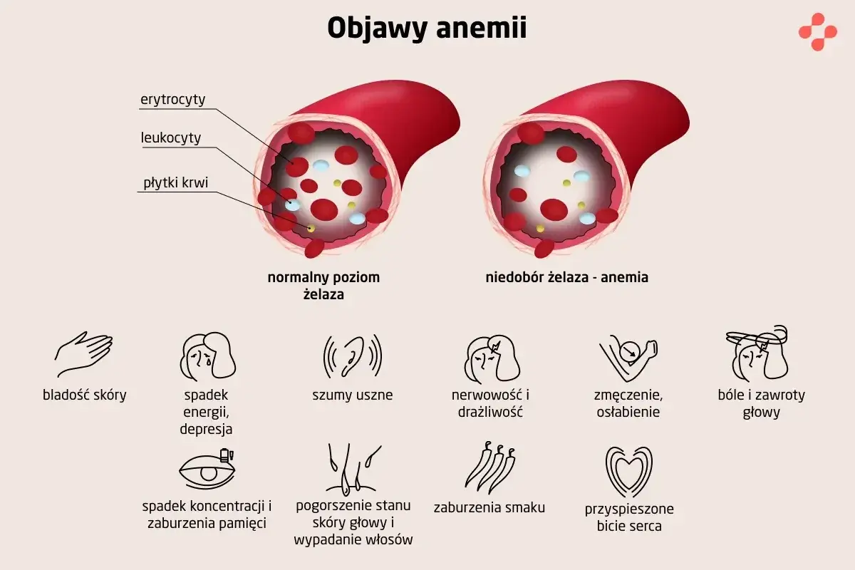 Objawy anemii: bladość skóry, spadek energii, szumy uszne, nerwowość, zmęczenie, bóle głowy, spadek koncentracji, pogorszenie stanu skóry i wypadanie włosów.