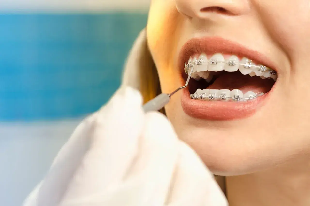 Uśmiech z aparatem ortodontycznym. Zastanawiasz się, ile kosztuje aparat na zęby? Dentysta sprawdza stan uzębienia.