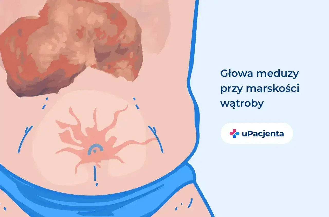 Ilustracja przedstawia brzuch z widocznymi żylakami i powiększoną wątrobą, symbolizującymi stan, gdy wyleczyłem marskość wątroby.