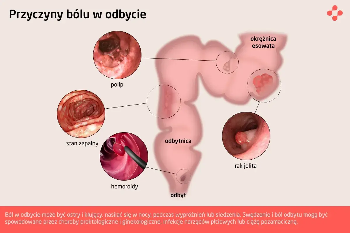 Ilustracja przedstawia przyczyny bólu w odbycie: polipy, stan zapalny, hemoroidy, raka jelita. Ból odbytu może być objawem wielu schorzeń.