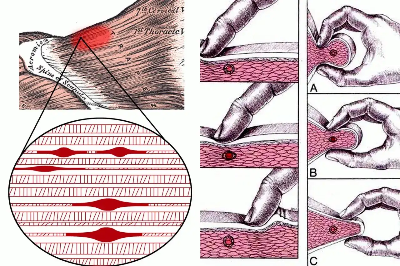 Ilustracja pokazuje punkty spustowe w mięśniach, ich lokalizację i metody palpacji.