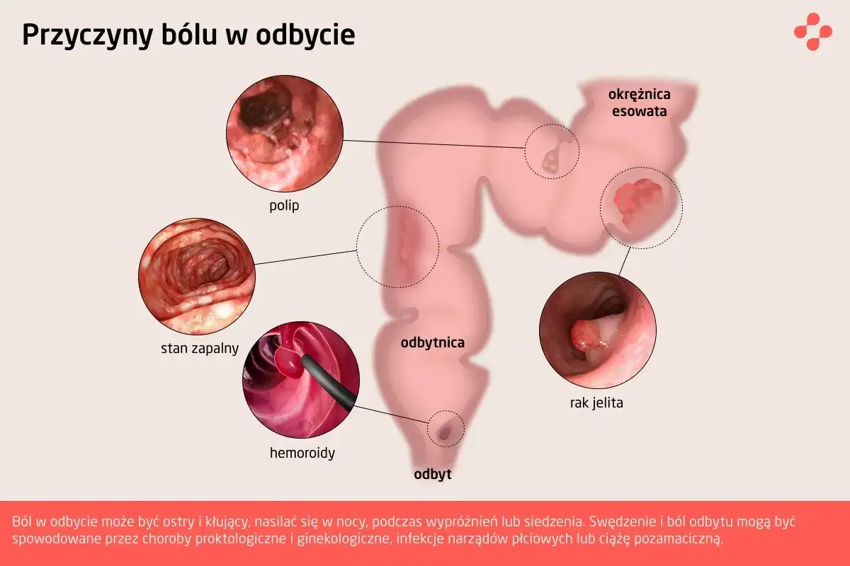 Ilustracja przedstawia przyczyny bólu w odbycie: polipy, stan zapalny, hemoroidy, raka jelita. Ból odbytu może być objawem wielu schorzeń.