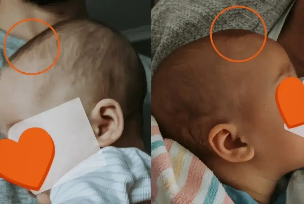 Dwa ujęcia główki niemowlęcia z zaznaczoną asymetrią, sugerującą plagiocefalię.