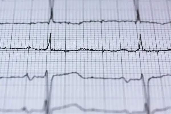 Nieregularne linie EKG na papierze milimetrowym, mogące wskazywać na migotanie przedsionków objawy.