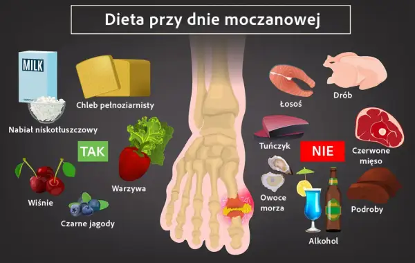 Dieta przy dnie moczanowej: zalecane nabiał, chleb pełnoziarnisty, warzywa, wiśnie, jagody. Unikaj czerwonego mięsa, podrobów, owoców morza, alkoholu. Leczenie wymaga zmian.