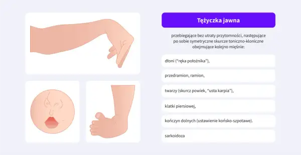 Tężyczka jawna: ilustracje przedstawiające rękę w pozycji "położnika", twarz z wykrzywionymi ustami i stopę.