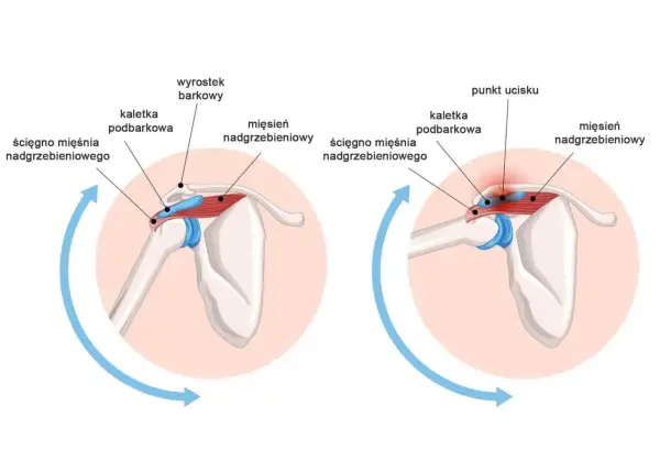 Ilustracja anatomiczna barku: prawidłowe położenie ścięgna i kaletki oraz ucisk na ścięgno.