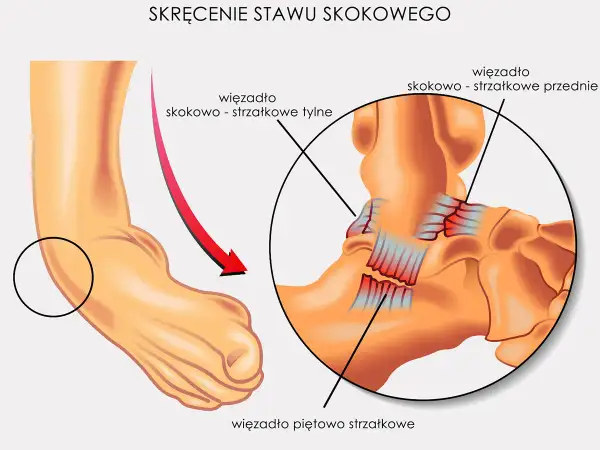 Ilustracja anatomiczna stawu skokowego z zaznaczonymi więzadłami i strzałką wskazującą skręt.