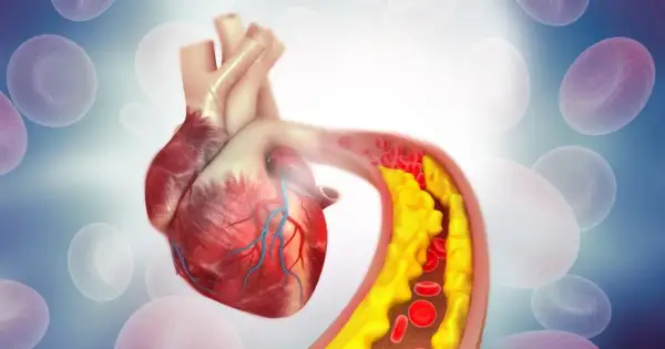 Serce z zatkanym naczyniem krwionośnym, gdzie gromadzi się żółty cholesterol, czyli wysoki poziom ldl.