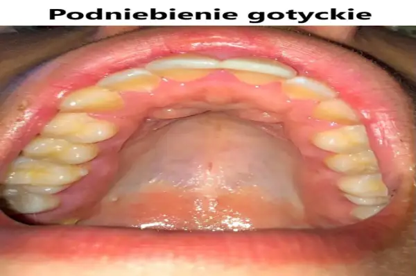 Widok jamy ustnej z zębami i podniebieniem. Charakterystyczne, wysokie podniebienie gotyckie.