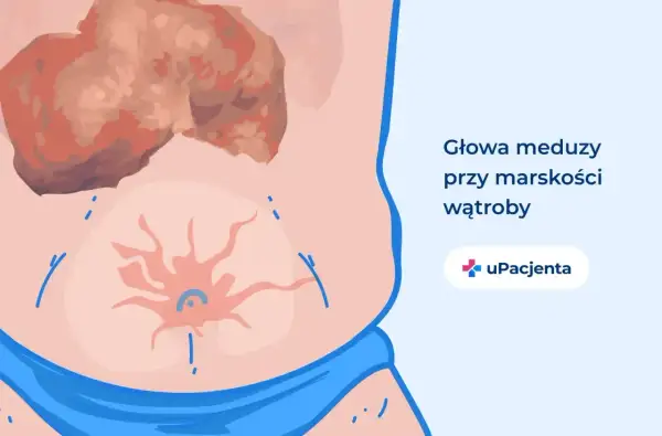 Ilustracja przedstawia brzuch z widocznymi żylakami i powiększoną wątrobą, symbolizującymi stan, gdy wyleczyłem marskość wątroby.